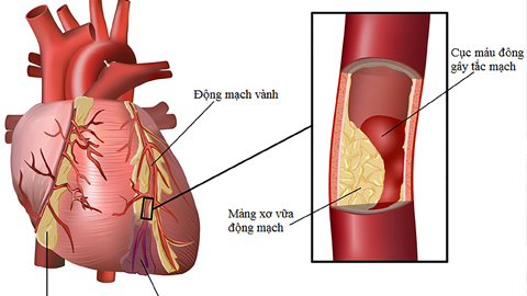 Hút thuốc lá và nguy cơ mắc bệnh động mạch vành