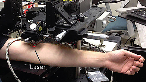 Công nghệ laser mới có thể tiêu diệt tế bào ung thư hắc tố