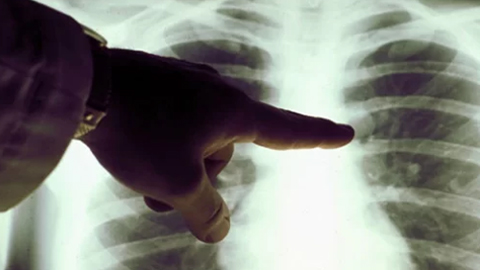Ung thư phổi: Cách nào giảm nguy cơ?