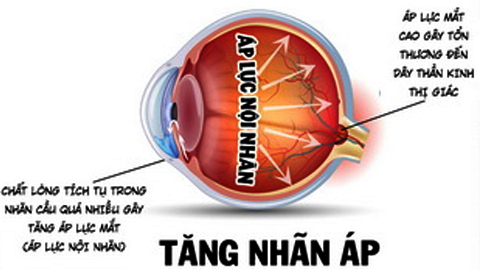 Bệnh tăng nhãn áp: Phát hiện sớm, giảm nguy cơ mất thị lực