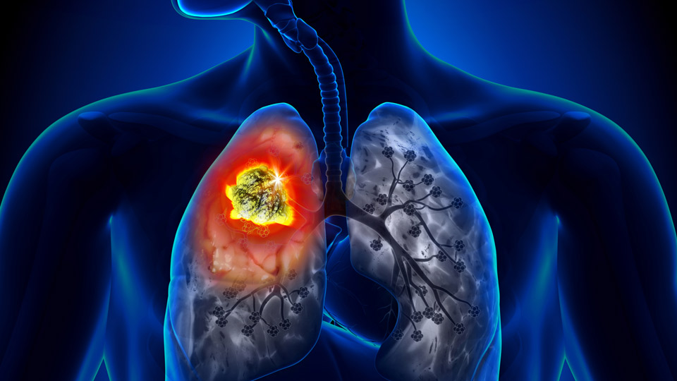 Phòng tránh ung thư phổi