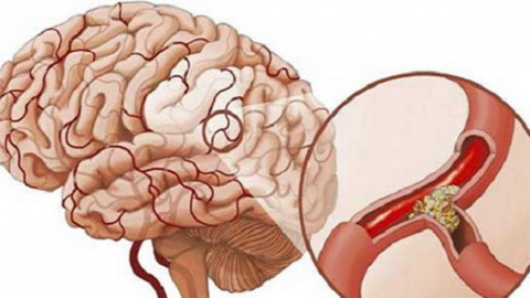 Một số biện pháp ngừa tai biến mạch máu não