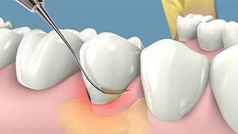 Cao răng và bệnh lý liên quan