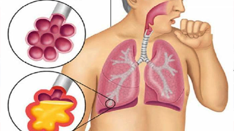 Nấm phổi do Aspergillus: Bệnh nguy hiểm nhưng ít người biết