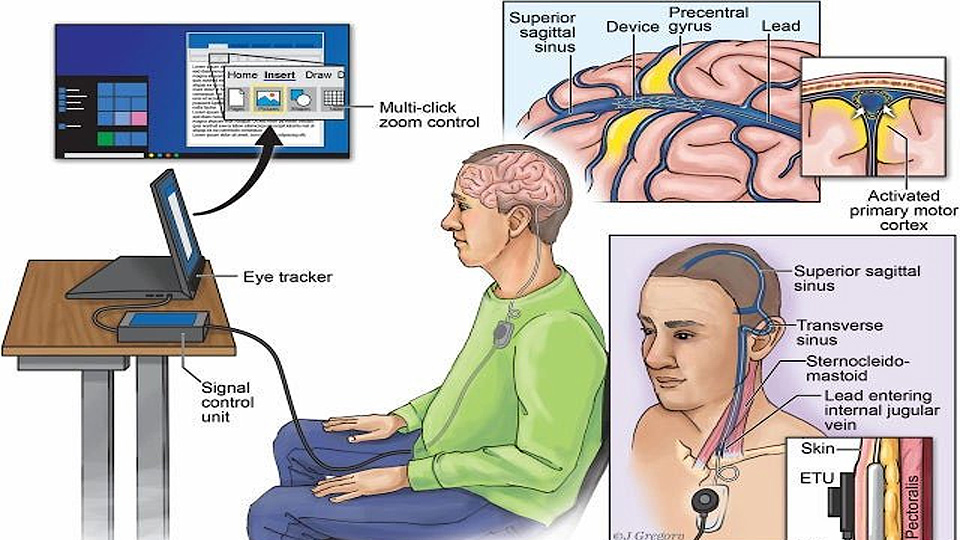 Kết nối não người với máy tính qua… mạch máu