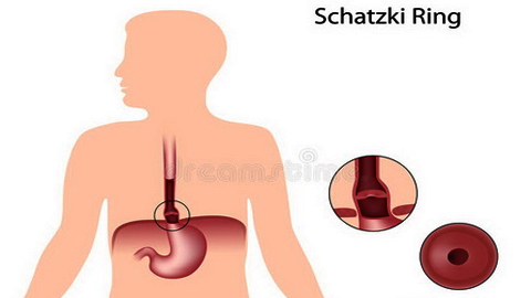 Vòng Schatzki gây khó nuốt cho bệnh nhân.