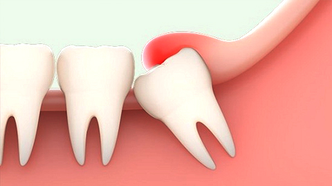 Việc hiểu biết về nguy cơ, biến chứng do răng khôn gây ra là rất cần thiết trong việc dự phòng các bệnh răng miệng.