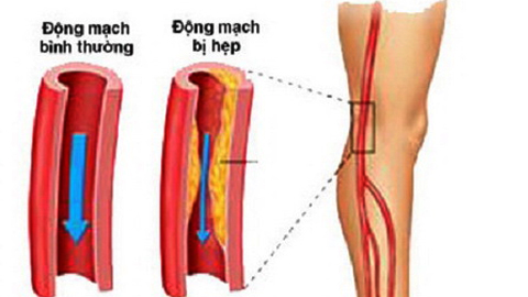 Xơ mỡ - một nguyên nhân gây hẹp động mạch chân.