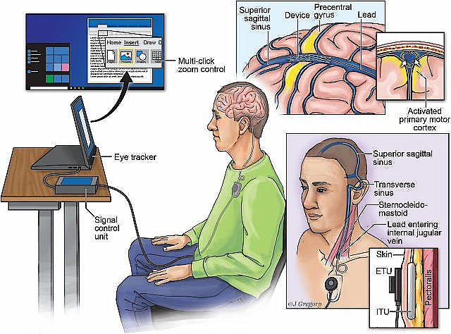 Ảnh minh họa cho phương pháp kết nối não bộ với máy tính qua mạch máu đăng trên tạp chí Journal of NeuroInterventional Surgery. 
