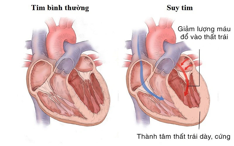 Ai dễ bị suy tim?