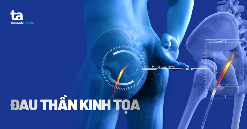 4 lưu ý giúp giảm đau thần kinh tọa