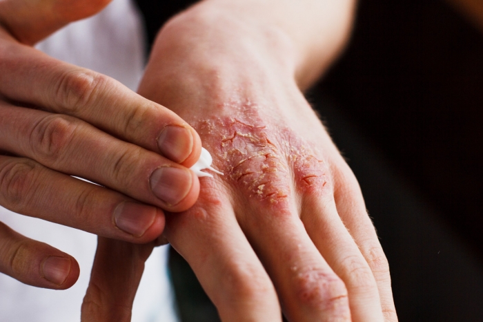 Viêm da tiếp xúc, nguyên nhân và thuốc điều trị