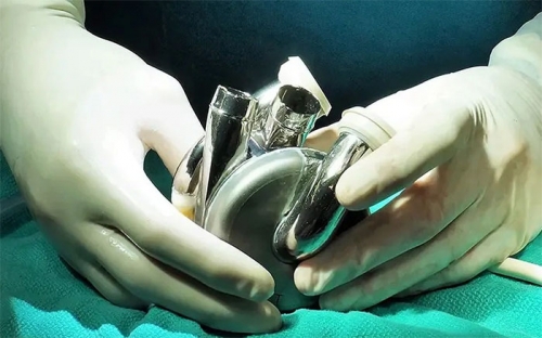 Úc phát triển thiết bị cấy ghép tim đột phá, mở ra hy vọng mới cho bệnh nhân suy tim