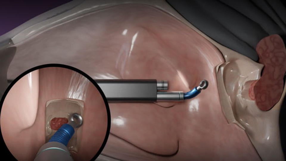 Bức ảnh cho thấy hệ thống Tamar Robotics, được sử dụng để loại bỏ một khối u tuyến yên qua mũi. Trong khoanh tròn là chế độ xem mà bác sĩ phẫu thuật nhìn thấy trên màn hình. Ảnh NoCamels

