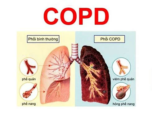 Hình ảnh tổn thương phổi do bệnh bệnh COPD.