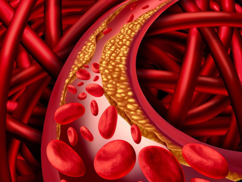 Rối loạn lipid máu có chữa khỏi được không?