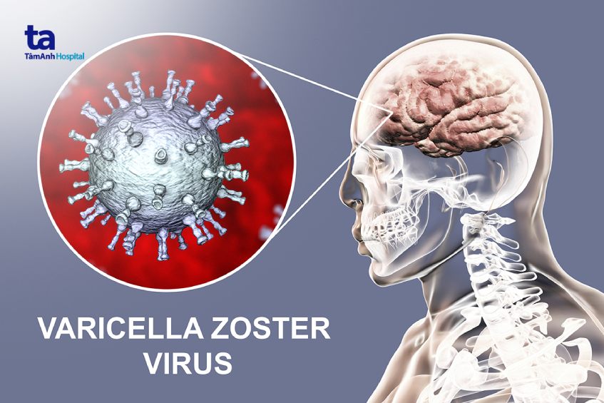 Virus thủy đậu có thể tấn công đến hệ thần kinh, đe dọa tử vong ở bệnh nhân