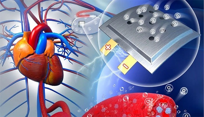 Máy điều hòa nhịp tim là một trong các thiết bị y tế được cấy vào cơ thể và phải được thay thế khi hết pin. (Ảnh: LV et.al/Chem).

