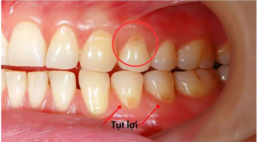 Tụt lợi lâu ngày không điều trị sẽ khiến tình trạng ngày càng nghiêm trọng.