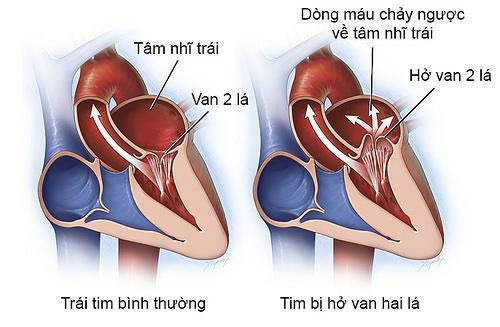 Hở van tim hai lá có nguy hiểm không?