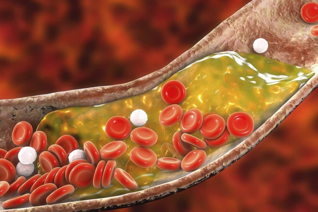 Làm cách nào để giảm cholesterol máu?