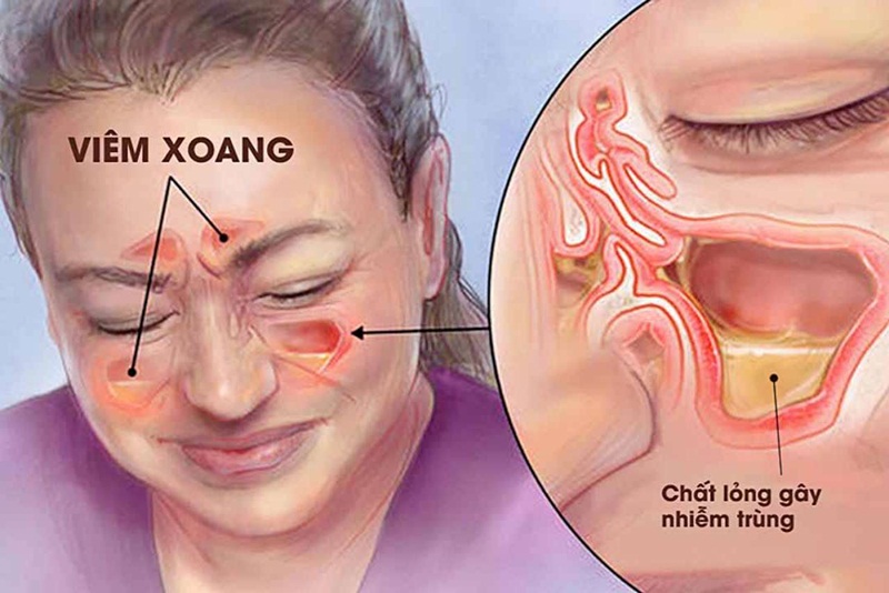 Chảy mũi, ngạt mũi và sốt nhẹ là những biểu hiện đặc trưng của viêm xoang cấp.