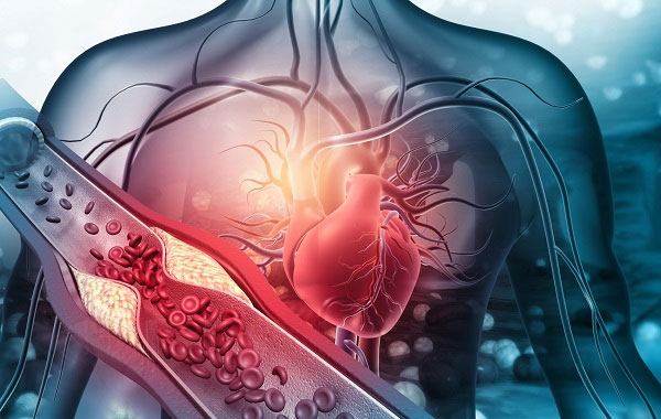 Mức cholesterol trong máu cao ảnh hưởng xấu đến sức khỏe tim mạch.