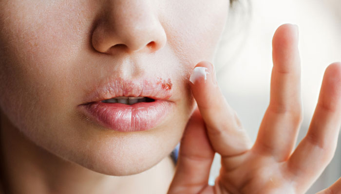 Nguyên tắc là điều trị mụn rộp Herpes bằng thuốc uống hay đường bôi và làm sạch bề mặt,...