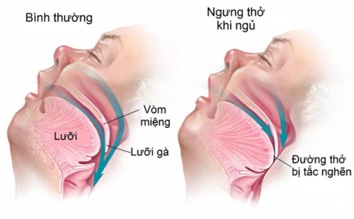 Biểu hiện mắc hội chứng ngưng thở khi ngủ