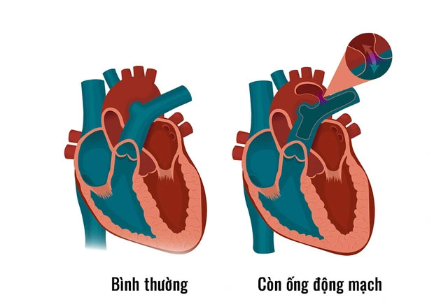 Còn ống động mạch: Nguyên nhân, triệu chứng, cách phòng ngừa và điều trị