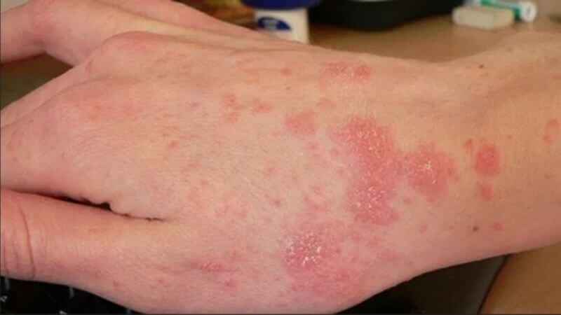 Cách chăm sóc da ở người bệnh chàm trong mùa hanh khô