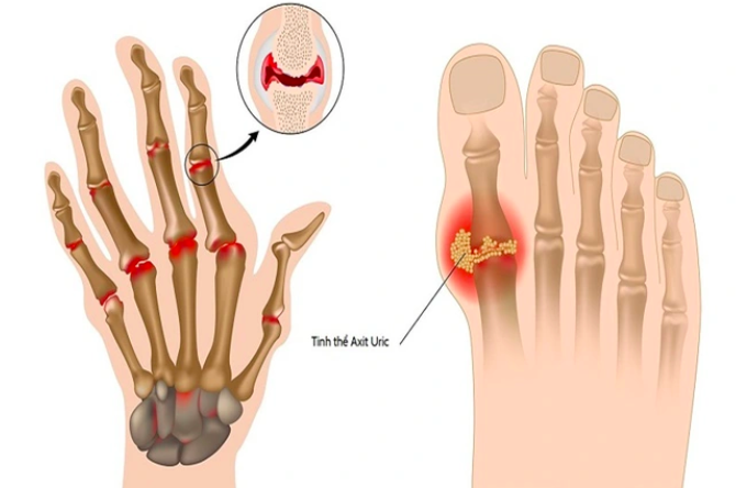 Nồng độ axit uric trong máu tăng cao là nguyên nhân hàng đầu gây ra bệnh gout