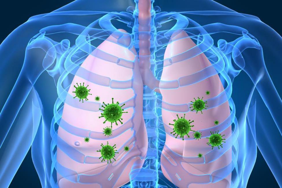 Viêm phổi lúc đầu có thể do virus cúm gây nên nhưng sau đó nhanh chóng chuyển sang bội nhiễm thêm các loại vi khuẩn như phế cầu và tụ cầu.