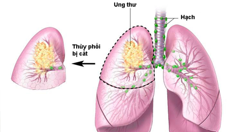 Thuốc lá và bệnh ung thư phổi