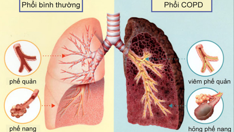 Những điều cần biết về bệnh phổi tắc nghẽn mạn tính