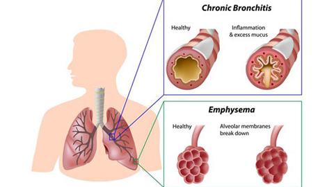 Bệnh phổi tắc nghẽn mạn tính - những điều cần biết