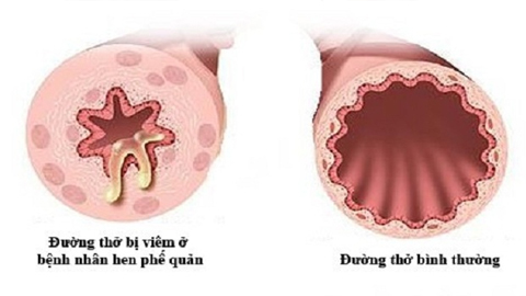 Những điều cần biết về bệnh hen phế quản