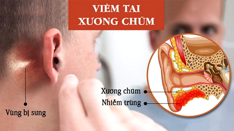 Đối phó với bệnh viêm tai hay gặp ở trẻ nhỏ