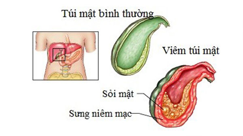 Viêm túi mật và những nguy biến