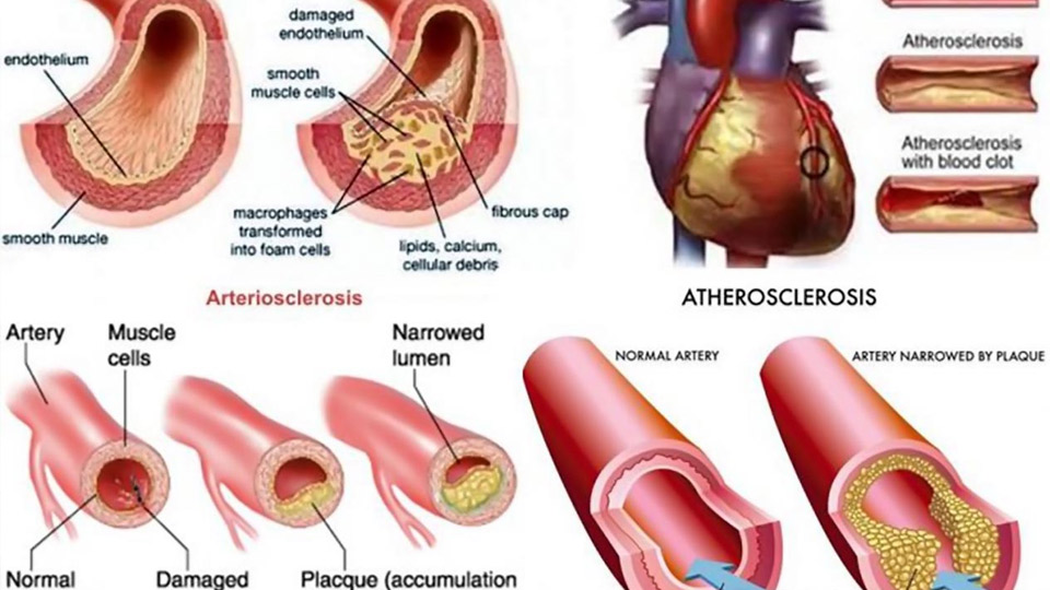 Nguyên nhân và cách phòng ngừa xơ vữa động mạch