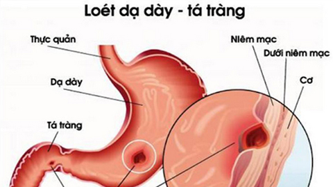 Thoái hóa niêm mạc dạ dày có nguy hiểm?