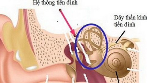 Đối phó chứng rối loạn tiền đình