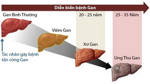 Rượu, bia gây xơ gan, ung thư gan thế nào?