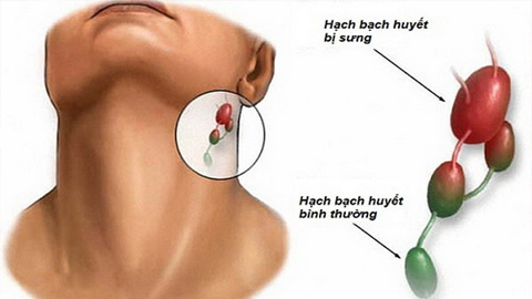 Nguyên nhân khiến cơ thể nổi hạch