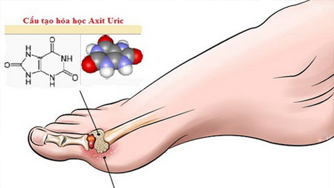 Xử trí tăng acid uric máu