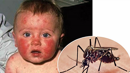 Bệnh Zika lây qua trung gian truyền bệnh là muỗi và khiến cho người bệnh có những nốt đỏ bất thường, sốt cao. (Ảnh: NY)