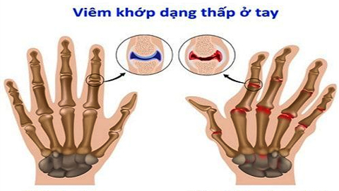 Biến dạng khớp bàn tay do viêm khớp dạng thấp.