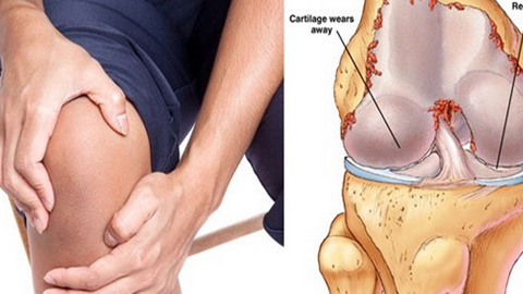 Thoái hóa khớp gối nếu không chữa trị sớm và đúng cách có thể gây biến chứng.