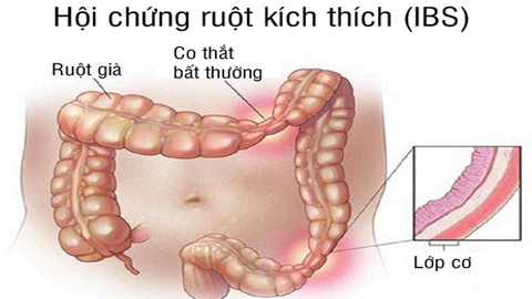 HCRKT là tình trạng rối loạn chức năng ruột.