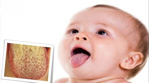 Nấm miệng ở trẻ sơ sinh biểu hiện chủ yếu trên bề mặt lưỡi với những mảng bám có màu trắng lâu ngày chuyển sang màu vàng.